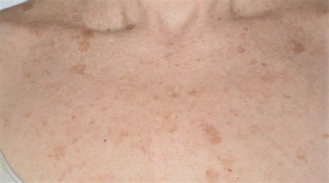 These pictures show lesions of different shapes and sizes. . Seborrheic keratosis under breasts pictures